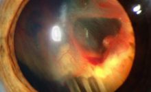 senales-para-detectar-un-desprendimiento-de-retina
