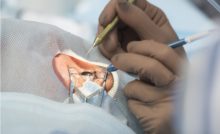 descubran-como-se-realiza-una-cirugia-de-desprendimiento-de-retina
