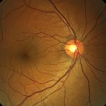 aprendan-a-reconocer-los-sintomas-de-la-degeneracion-macular