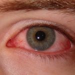 sindrome-de-ojo-seco-la-causa-mas-comun-para-acudir-al-oftalmologo